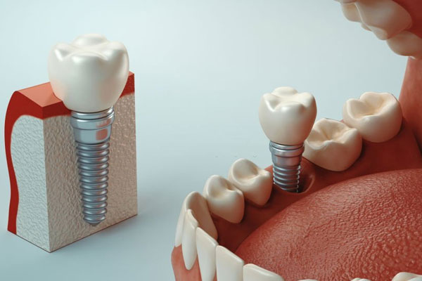 dental-implants