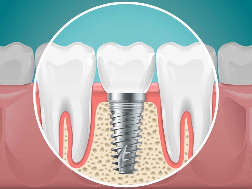 dental-tourism-dental-implants