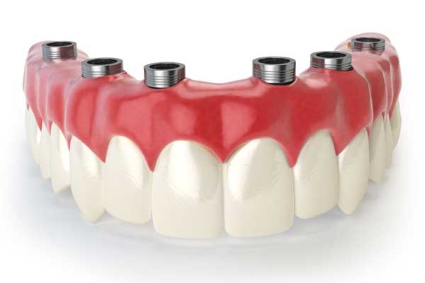 implant-supported-removable-and-fixed-dentures