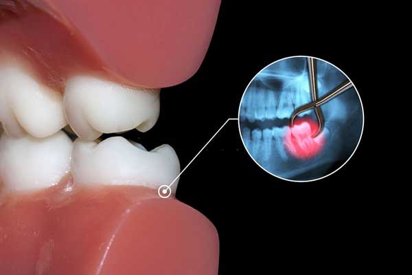 painless-tooth-removal