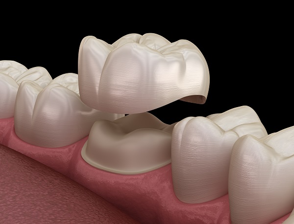 dental-crowns